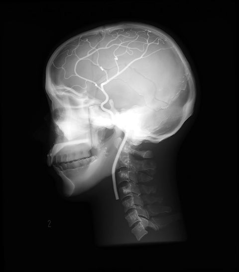 Model de cap angiografic