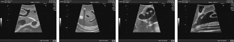 Fantomă de ultrasunete abdominale intraoperatorie și laparoscopice