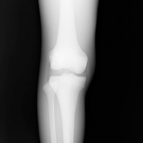 Fantomă CT pentru ligamentele genunchiului