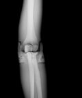 Fantomă radiografică secțională cu oase artificiale - Cot drept, opac