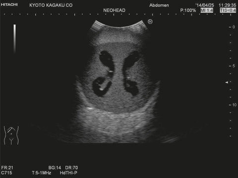 Fantomă cap neonatal cu hidrocefalie pentru ecografie