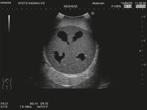 Fantomă cap neonatal cu hidrocefalie pentru ecografie