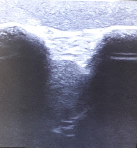 Ultrasound - Exercise Model Shoulder