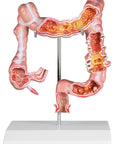 Model colon cu patologii