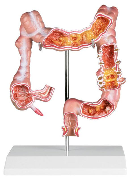 Model colon cu patologii